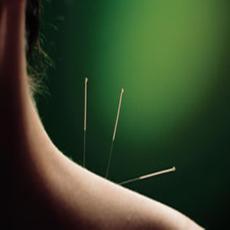 3 acupuncture needles in a person's neck and shoulder | Song's Acupuncture & Herbal Clinic | John Song